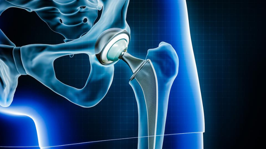 Orthopaedic and Joint Replacement